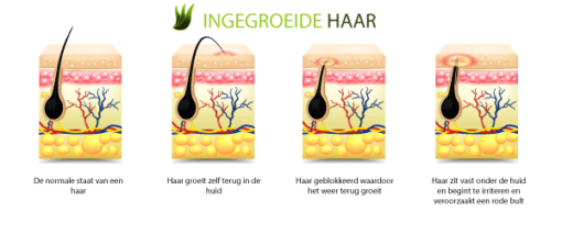 Ingegroeide haren Zo kom je er vanaf Anti ingroeiende haar AloëClear